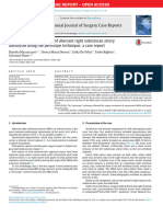 Chimmeny For Aberrant Subclavian