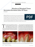 Miller Classification of Marginal Tissue