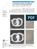 A Case of Interstitial Pneumonia, Myocarditis Caused by C.pneumoniae