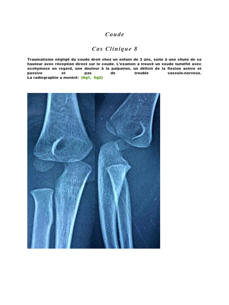 Fractures du Condyle Externe chez l'Enfant | PDF | Médecine clinique ...