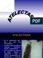 Atelectasia Enfisema