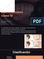 Maloclusion Clase III