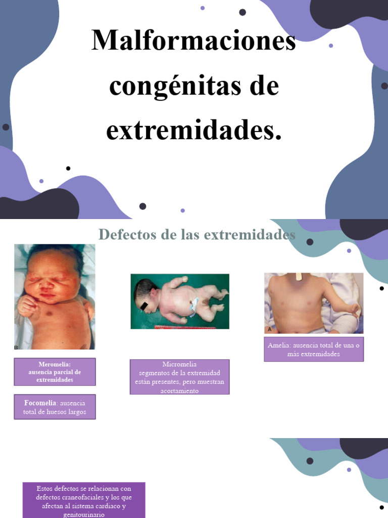 Malformaciones Congénitas de Extremidades | PDF | Desorden congenito ...