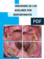 Osteonecrosis de Los Maxilares Por Bifosfonatos