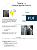 Fracture Pertrochantérienne