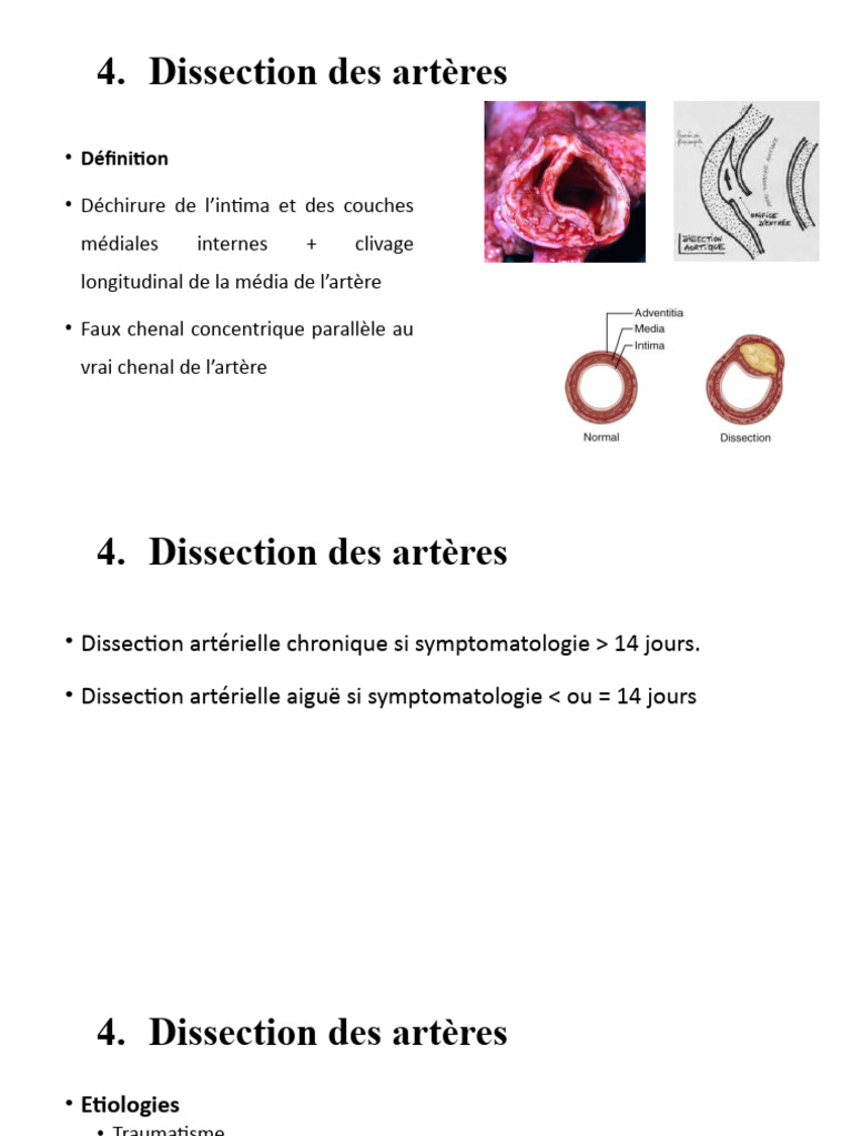 Ciseaux De Dissection Dentaire & Chirurgicale - Acier Inoxydable - Pour Suture, Gencive, Tissus - MEDSPO