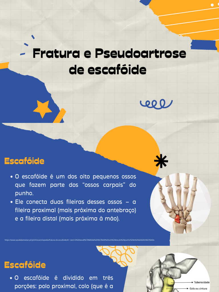 Fratura e Pseudoartrose do Escafóide | PDF | Epidemiologia ...
