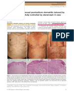 Histologically-Diagnosed Psoriasiform Dermatitis Induced by Nivolumab Successfully Controlled by Etanercept - A Case Report