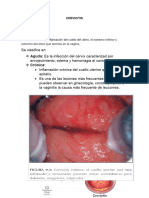 Cervicitis ..Patologia