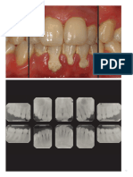 Periodontitis Estadio 1