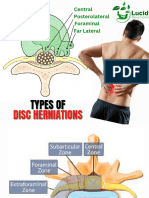 Disc Herniations