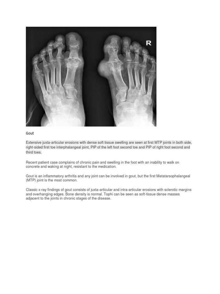 Gout intelligence overview