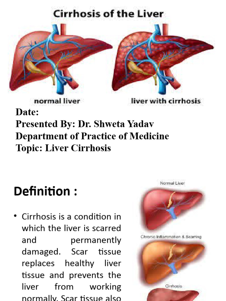 Liver Cirrhosis Pdf