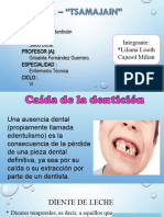 Caida de La Denticion