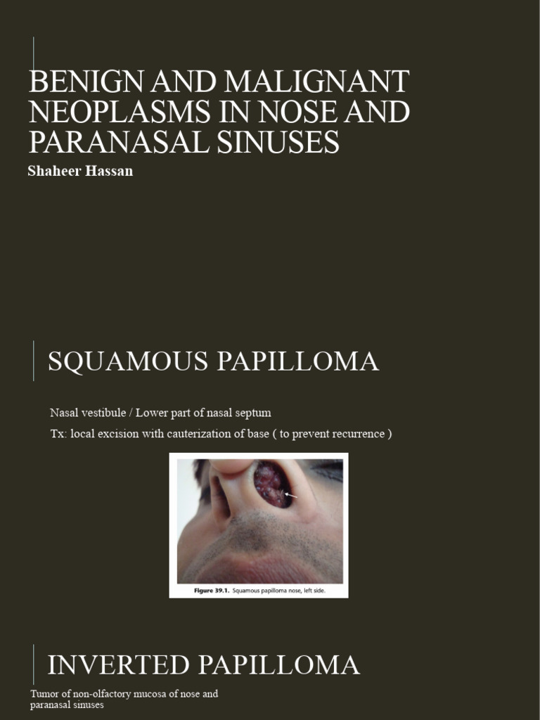 Neoplasms of Nose and Paranasal Sinus | PDF | Human Nose | Human Anatomy