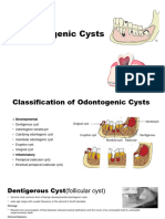 Odontogenic Cyst