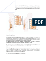 Espondilitis Anquilosante