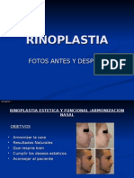 Rinoplastia fotos antes y después