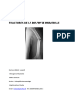 FX Diaphyse Humerus