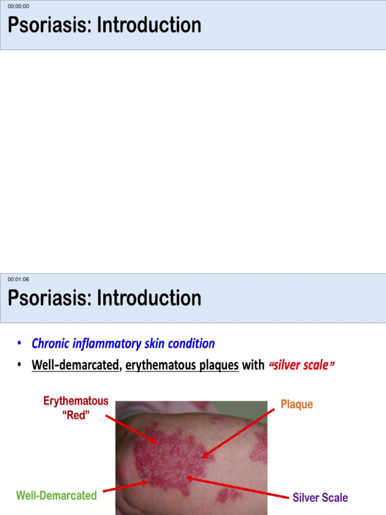 Overview of psoriasis what causes it what makes it worse subtypes