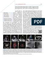 Rare Cause of Recurrent Pericardial Tamponade: Cardiac Angiosarcoma