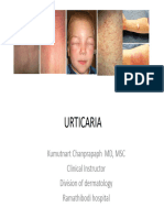 Urticaria