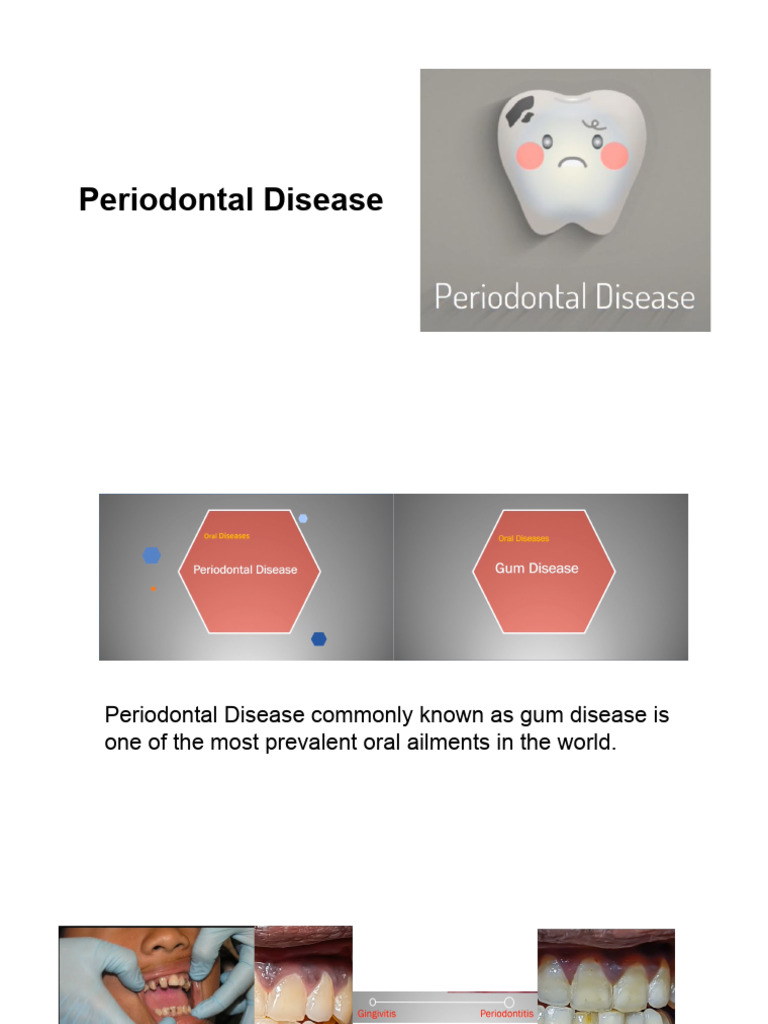 Video 1.4 Periodontal Disease | PDF | Periodontology | Oral Hygiene