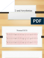 ECG and Arrythmias