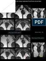 Fistules Ano Périnéales Crohn