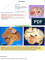 19 Meningeoma