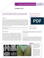 Denervation Hypertrophy in L5 Radiculopathy