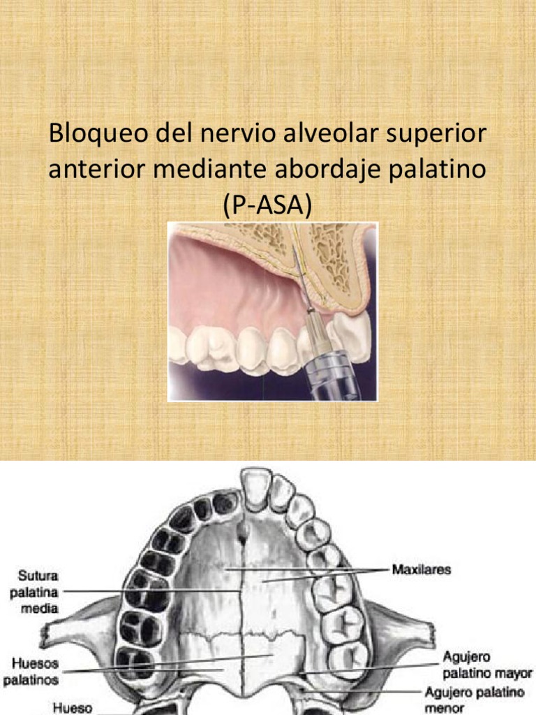 Bloqueo Del Nervio Alveolar Superior Anterior Mediante Abordaje