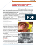 Molar Impactions: Etiology, Implications and Treatment Modalities With Presentation of An Unusual Case