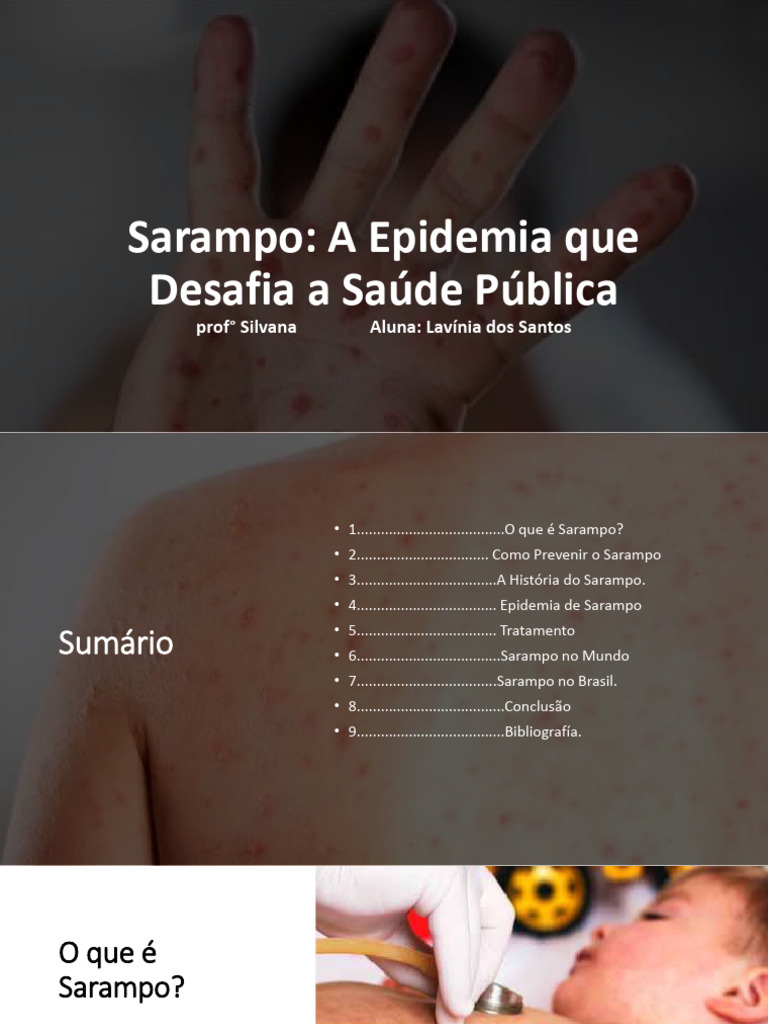 Slide Sobre Sarampo | PDF