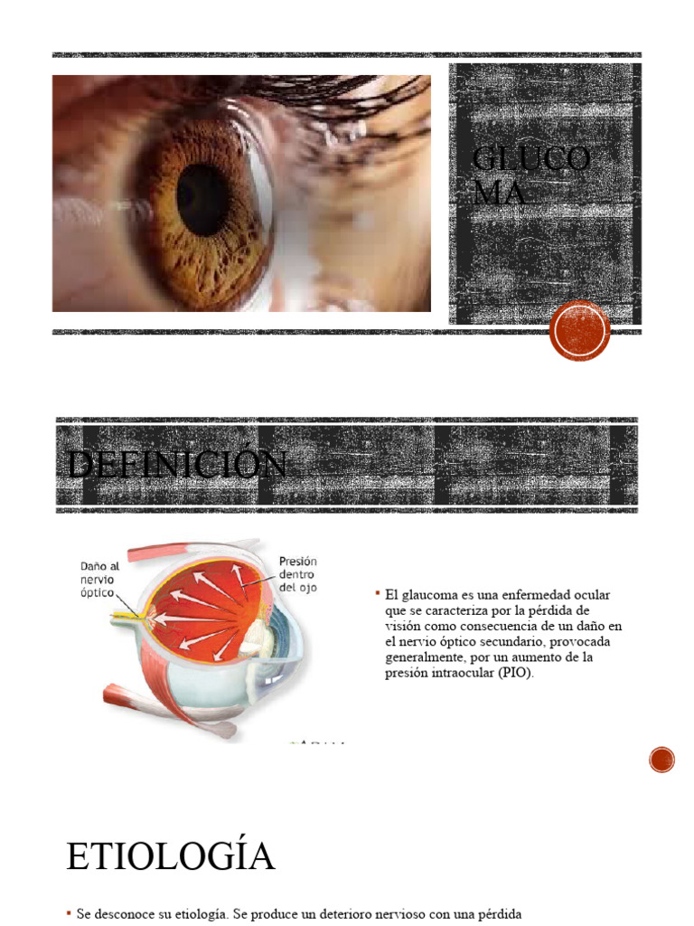 Tipos y Tratamientos del Glaucoma | PDF | Glaucoma | Ojo humano