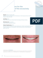 Digital Workflow For The Rehabilitation of The Excessively Worn Dentition