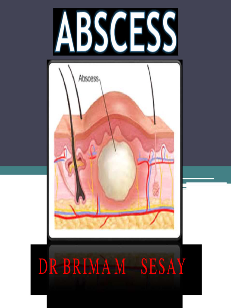 Understanding Abscess Types and Treatments | PDF