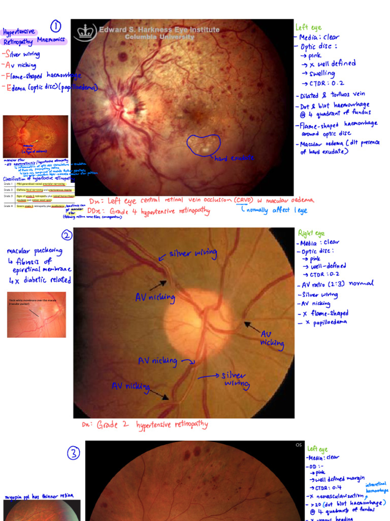 Hypertensive Retinopathy Findings | PDF | Ophthalmology | Human Eye