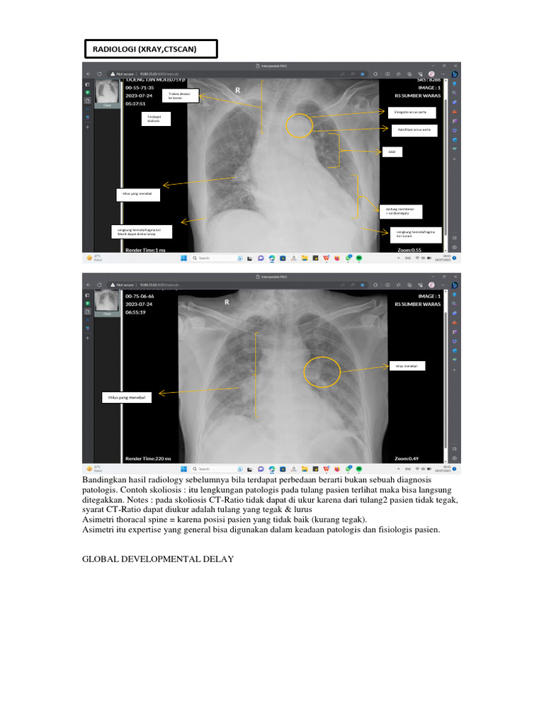Analisis Radiologi dan Temuan Klinis | PDF