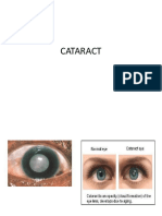 Cataract 1