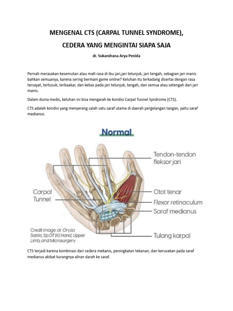 Penanganan Carpal Tunnel Syndrome | PDF | Sains & Matematika