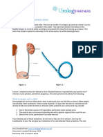 Ureteric Stent and Removal