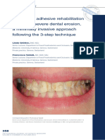 Full-mouth adhesive rehabilitation in a case of severe dental erosion