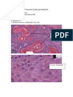 Carcinom tế bào gai sừng hóa 1