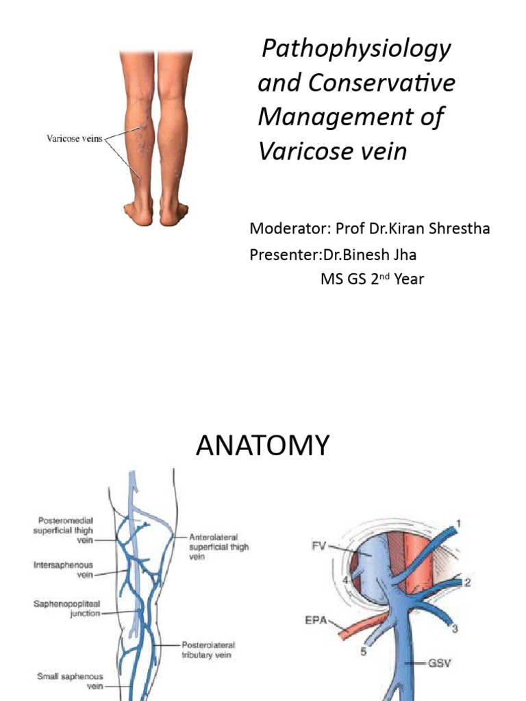 Varicose Veins: Pathophysiology & Management | PDF | Vein | Edema