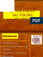 Le Volvulus Du Colon Pelvien