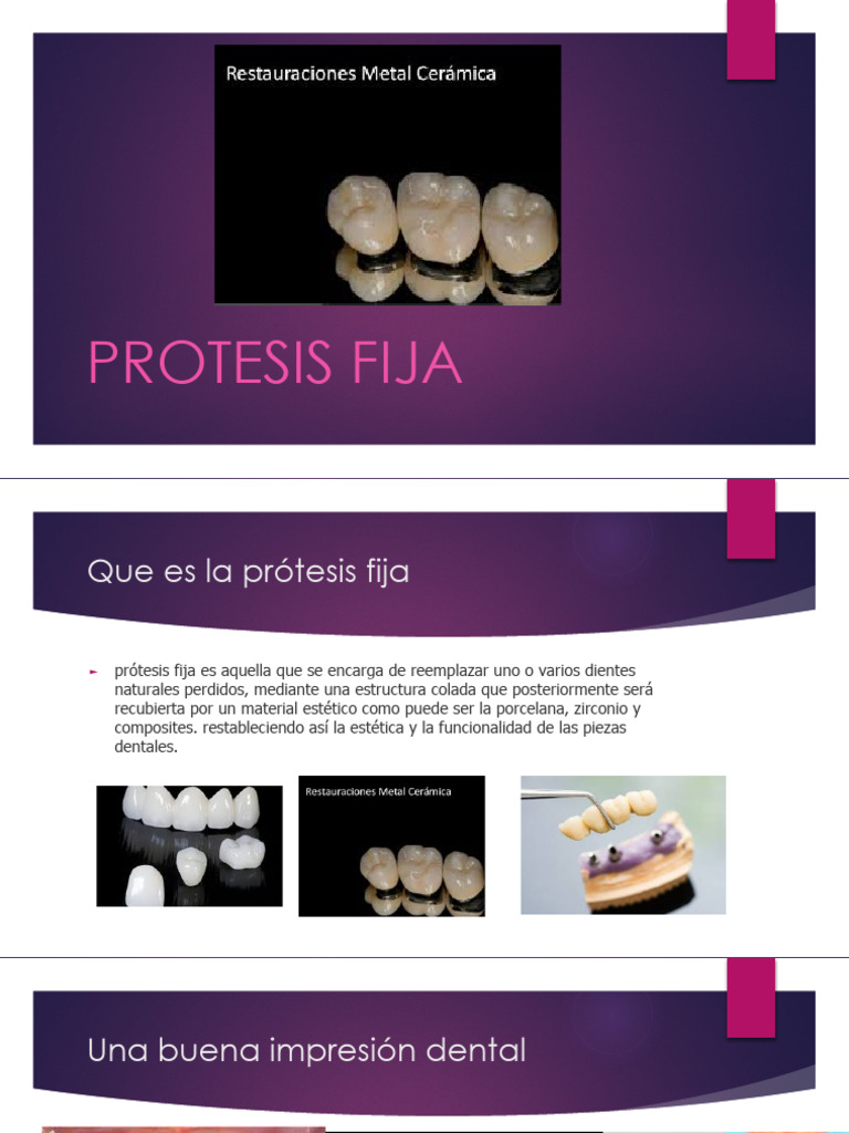 Protesis Fija | PDF | Dentadura postiza | Porcelana