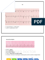 Normal ECG: - P Wave: Between 3 - 5 Little Square - Lead V1 Is A Good Place To Start
