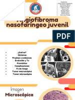 Angiofibroma Nasofaríngeo Juvenil