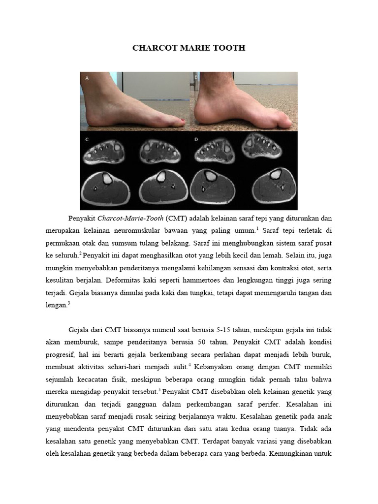 Charcot Marie Tooth | PDF